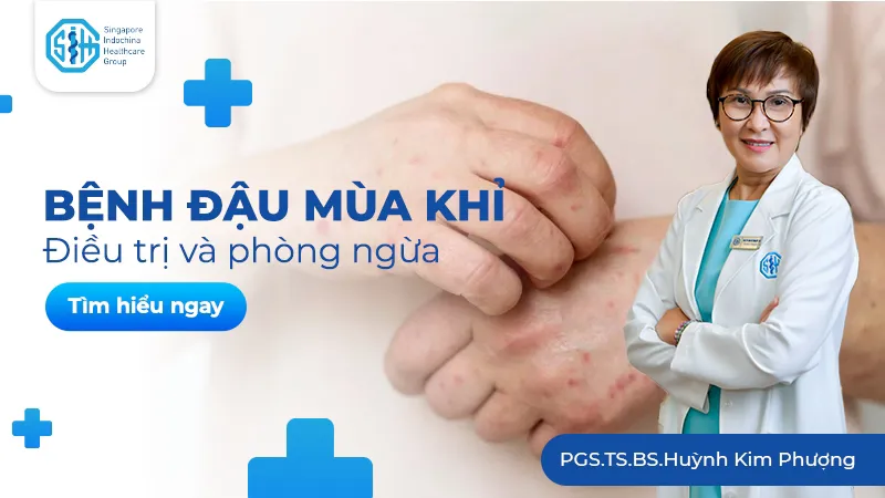 BỆNH ĐẬU MÙA KHỈ CÓ PHẢI LÀ ĐẠI DỊCH KẾ TIẾP?