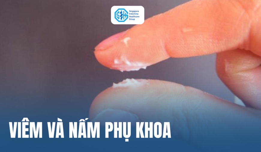 Viêm và nấm phụ khoa: Cách nhận biết, nguyên nhân và điều trị
