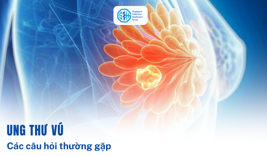 Những Câu Hỏi Thường Gặp Về Ung Thư Vú
