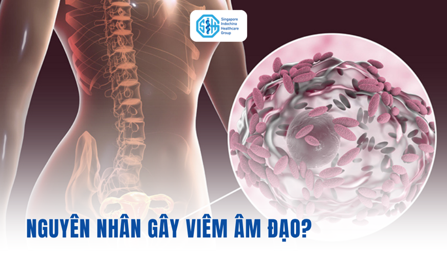08 Nguyên Nhân Gây Viêm Âm Đạo - Những Lý Do Cần Lưu Ý