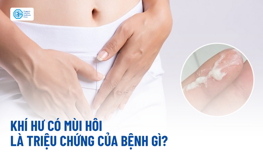 Khí hư có mùi – Dấu hiệu bất thường phụ nữ không nên bỏ qua