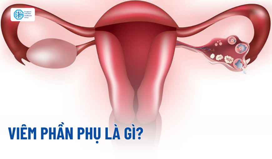Viêm phần phụ là gì? Dấu hiệu nhận biết và triệu chứng cảnh báo sớm