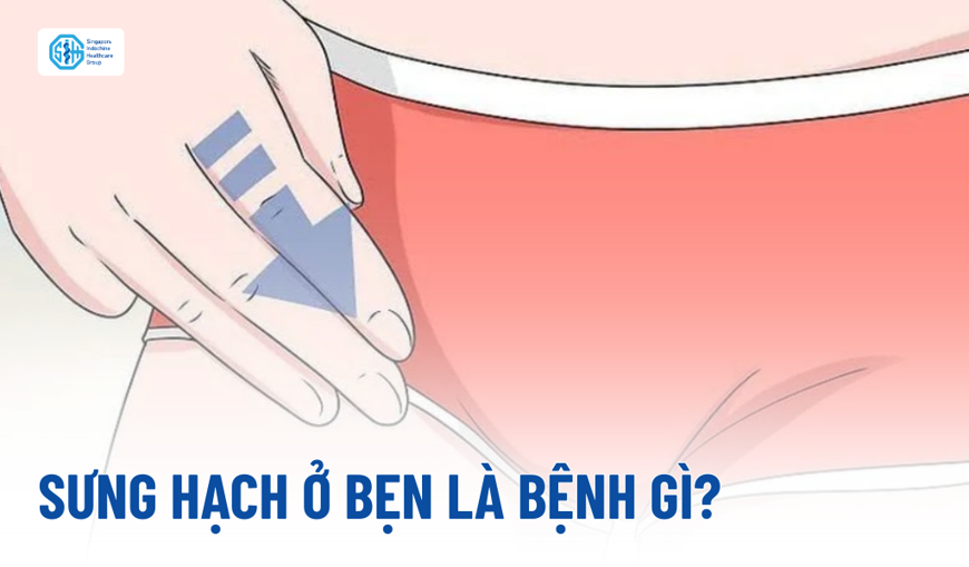 Sưng hạch ở bẹn là bệnh gì? Dấu hiệu nào cho thấy bạn cần đi khám ngay?