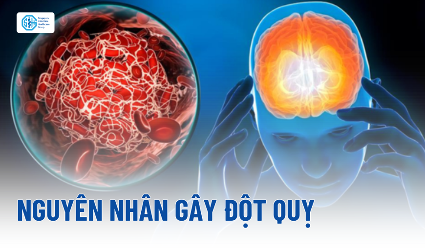 Nguyên nhân gây đột quỵ: Nhận diện yếu tố bệnh lý và lối sống
