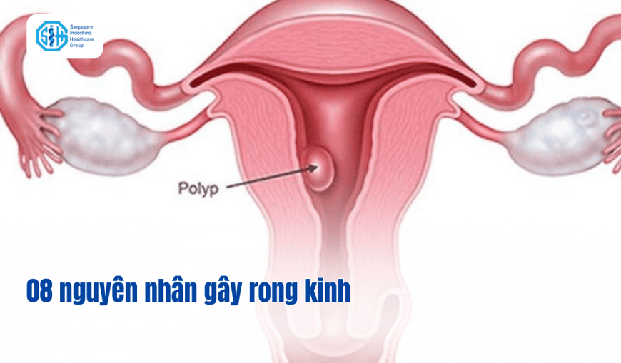 08 nguyên nhân rong kinh phổ biến ở phụ nữ và cơ chế hình thành triệu chứng