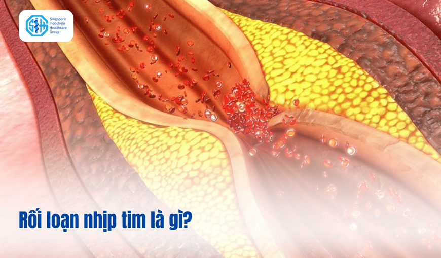 Rối loạn nhịp tim là gì? Nguyên nhân, triệu chứng và chẩn đoán?