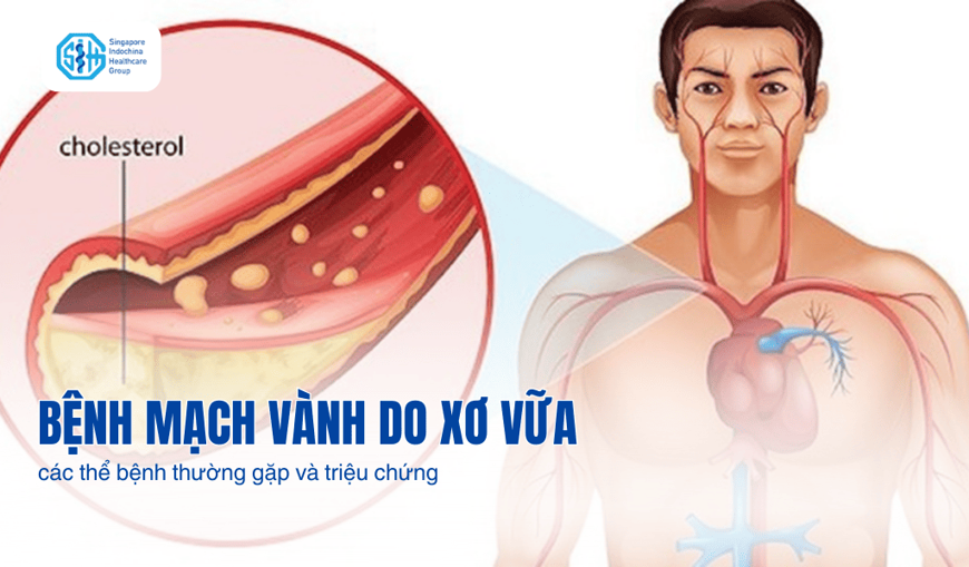Bệnh mạch vành do xơ vữa: các thể bệnh thường gặp và triệu chứng