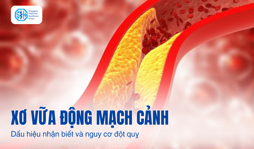 Xơ vữa động mạch cảnh ở người cao tuổi: Dấu hiệu nhận biết và nguy cơ đột quỵ