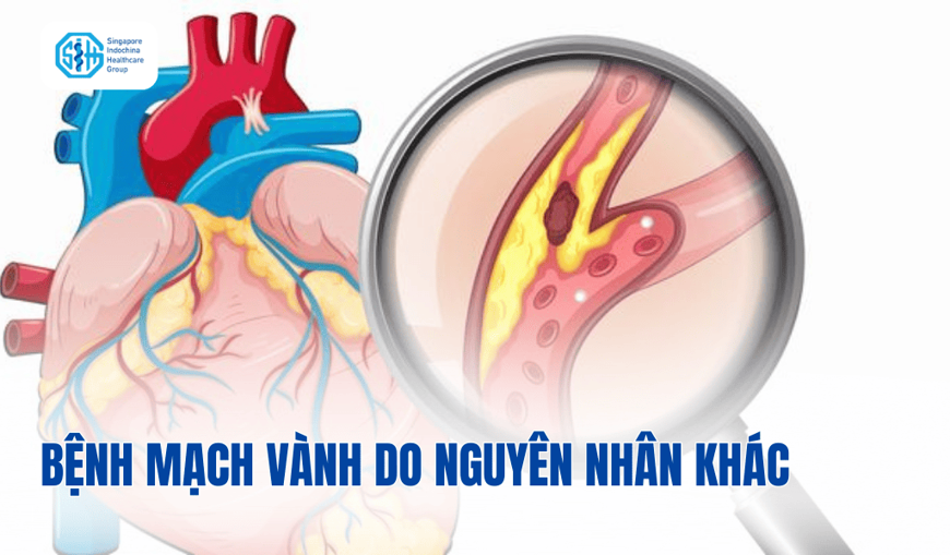 Bệnh động mạch vành do nguyên nhân khác