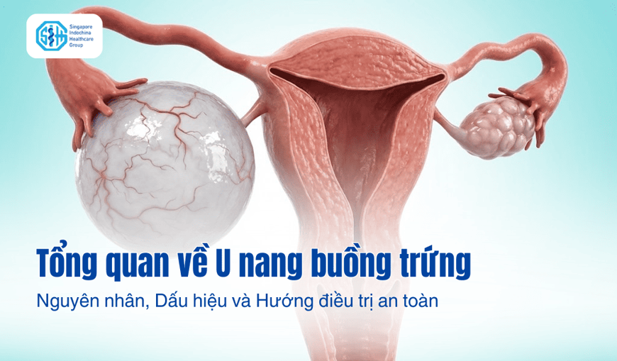 Tổng quan về U nang buồng trứng: Nguyên nhân, Dấu hiệu và Hướng điều trị an toàn