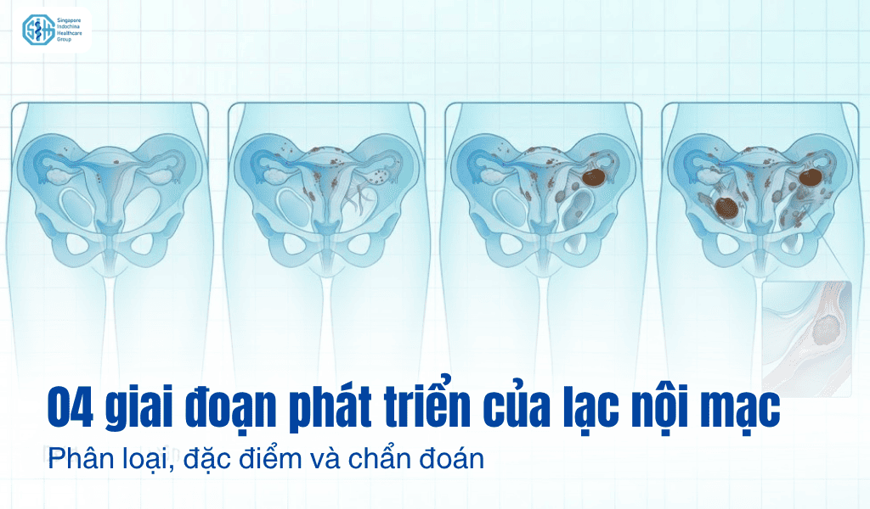 4 giai đoạn phát triển của lạc nội mạc tử cung: Phân loại, đặc điểm và chẩn đoán