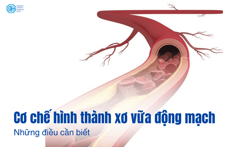 Cơ chế hình thành xơ vữa trong tim mạch và những thông tin cần biết