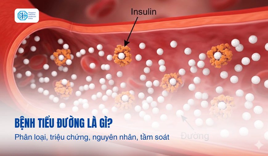 Bệnh tiểu đường là gì? Phân loại, triệu chứng, nguyên nhân, tầm soát